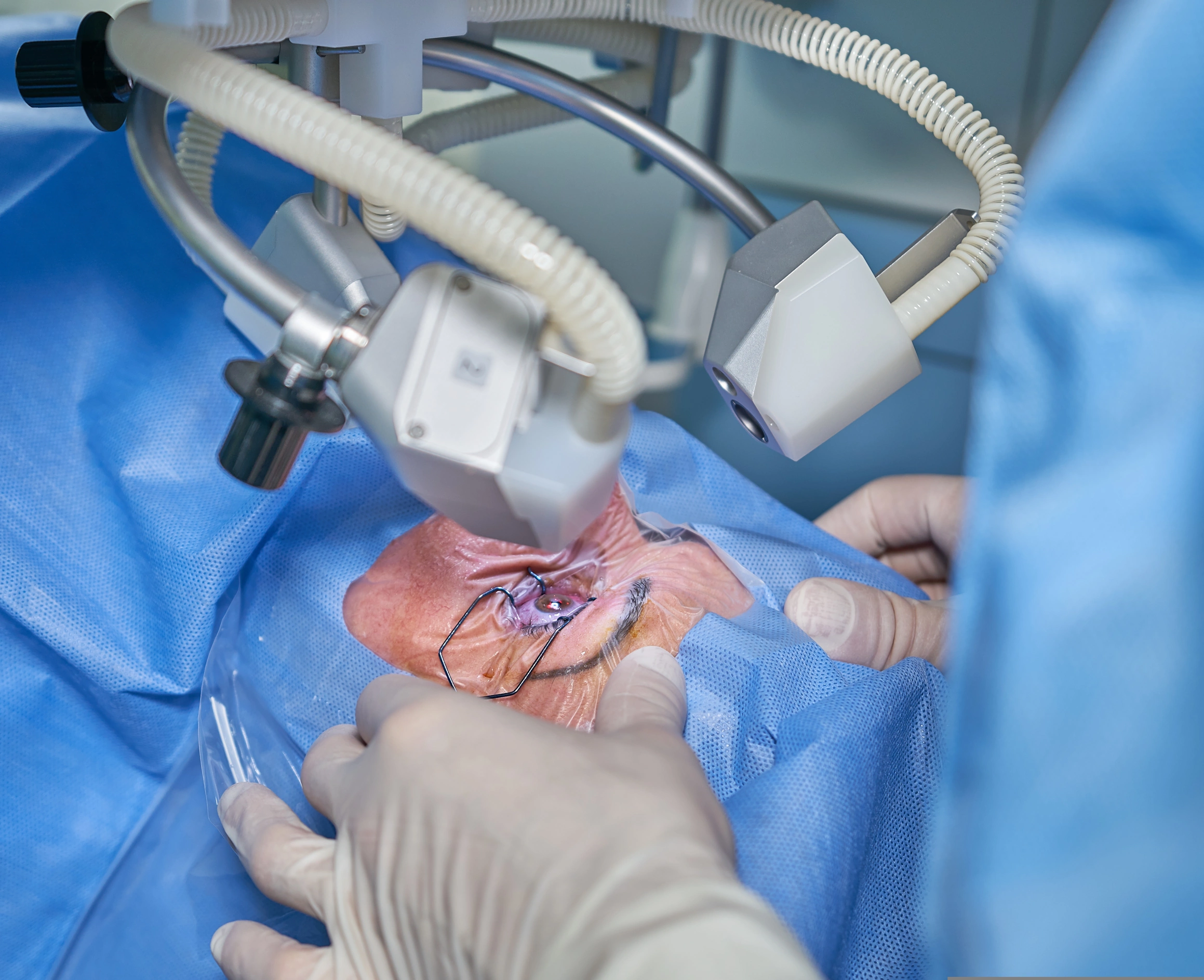 Augenop Laser